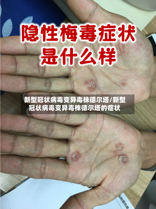 新型冠状病毒变异毒株德尔塔/新型冠状病毒变异毒株德尔塔的症状