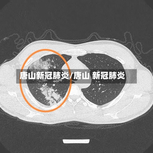 唐山新冠肺炎/唐山 新冠肺炎-第3张图片
